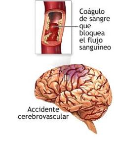 Accidente CerebroVascular (ACV) que le provocó un ataque cerebral y provocó que el hemisferio izquierdo de su cerebro se desconectara de la realidad